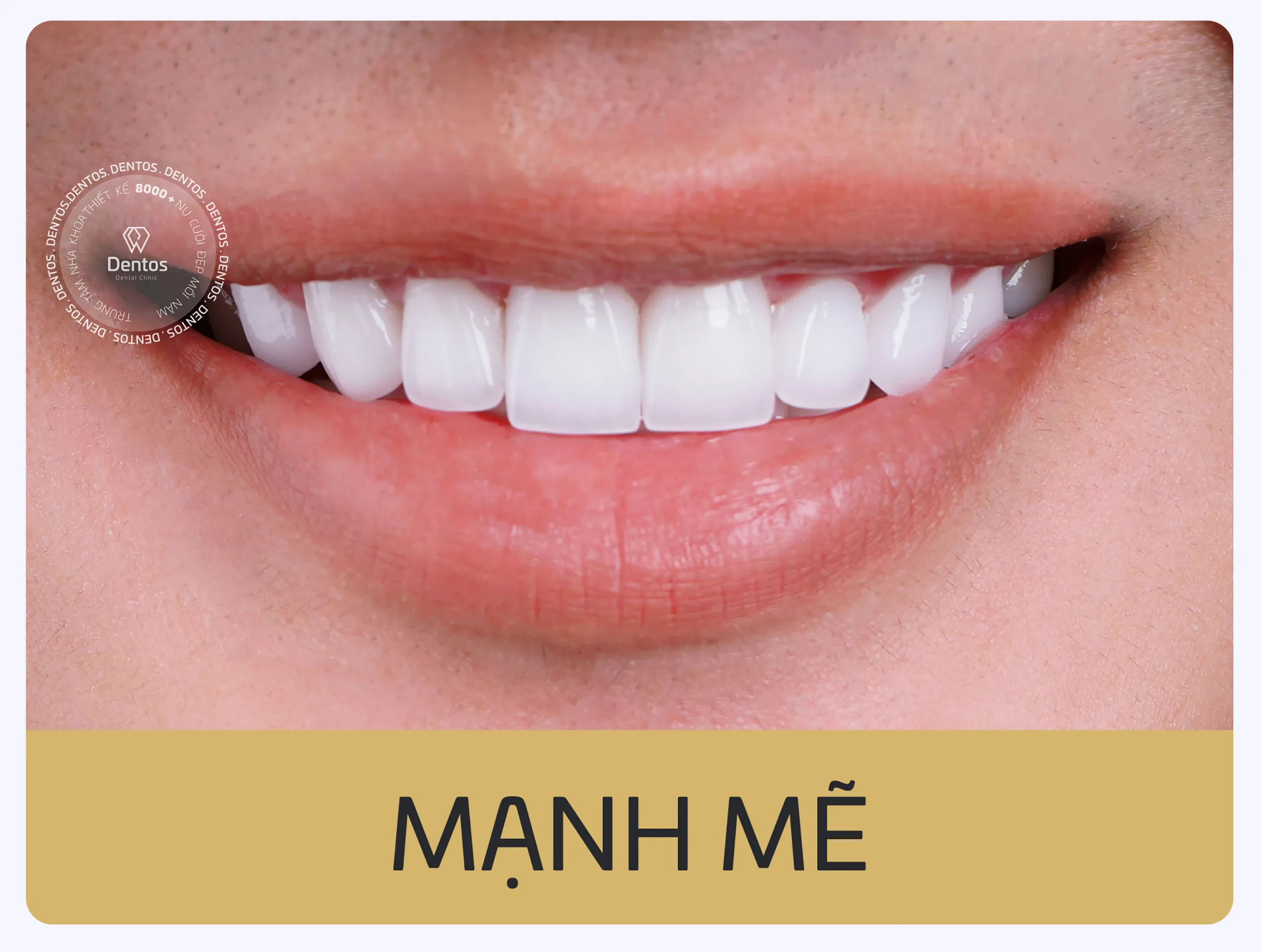 Mẫu răng sứ dáng Mạnh Mẽ